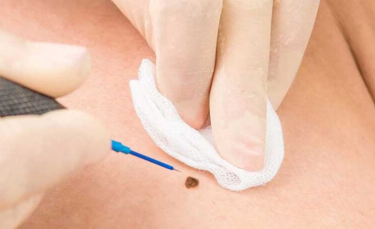 Removal of moles